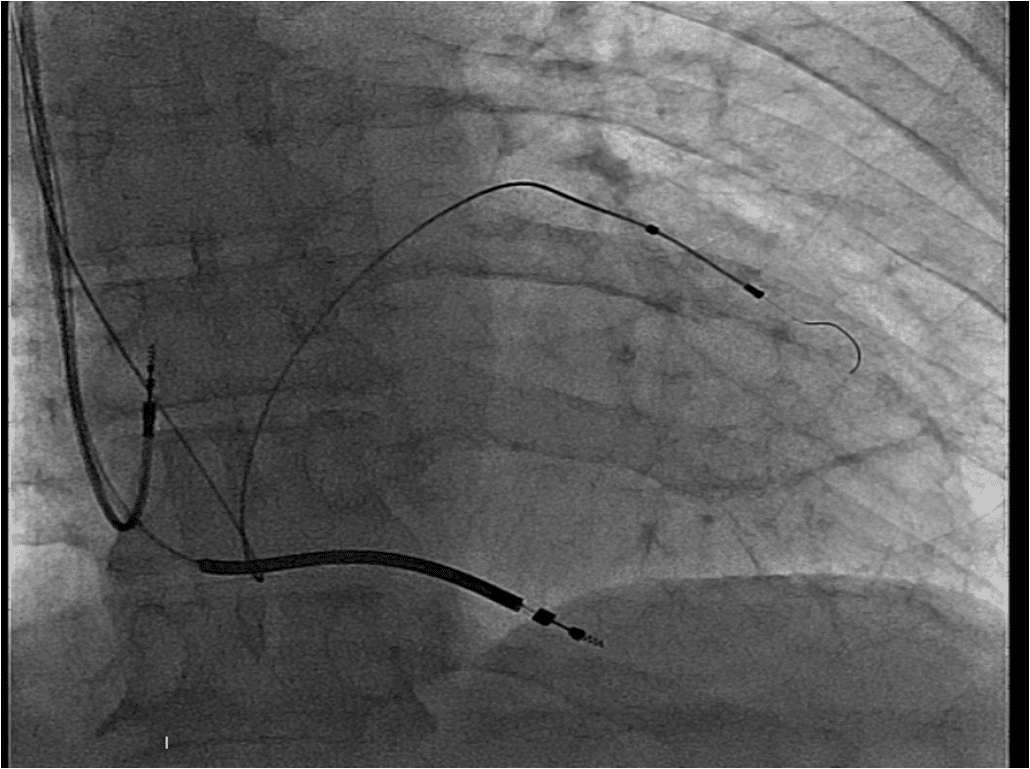 Figure 2. Successful implantation of all leads by the right sided approach